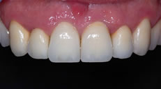 Dettaglio arcata superiore (fig. 5)